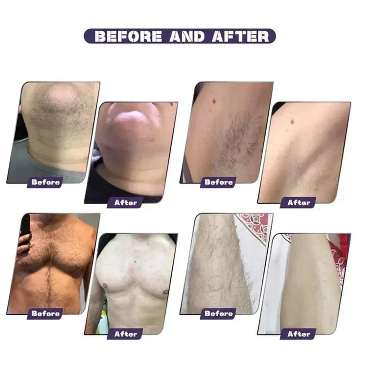 2025 Picosecond laser 3500W diode laser hair removal tattoo removal machine Chloasma Machine Painless Laser Tattoo Removal