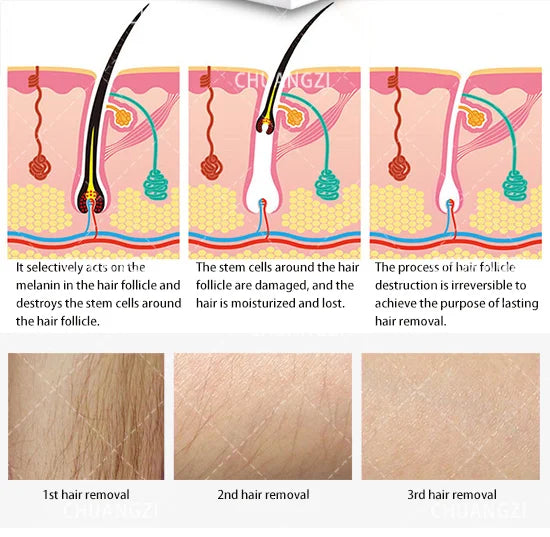 3000W 3 Wavelength 808 Diode Laser Hair Removal Machine Ice Titanium Permanent Painless Physical Body Care Depilation Epilator